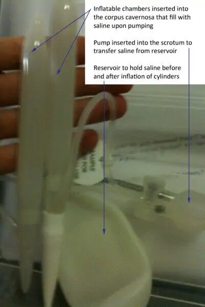 Penile_prosthesis