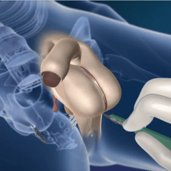 Male to female sex reassignment surgery