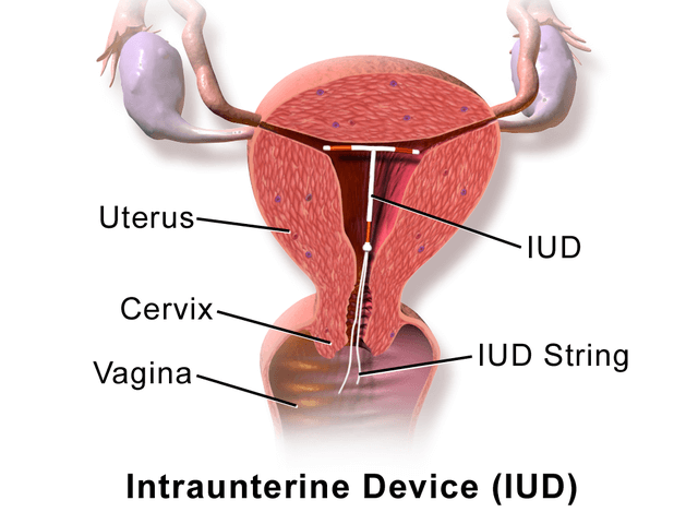 A medical diagram of a uterus with an IUD inserted inside.