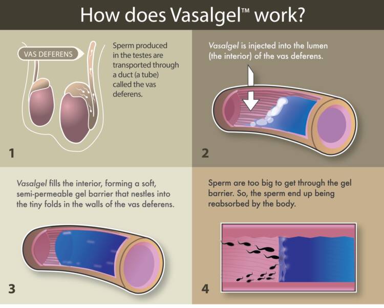 Vasalgel infographic via Revolution Contraceptives. 